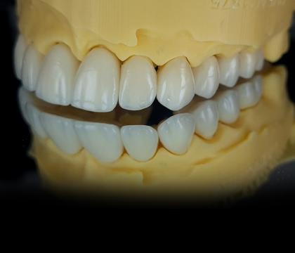 Licówki/korony/mosty