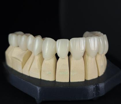 Licówki/korony/mosty