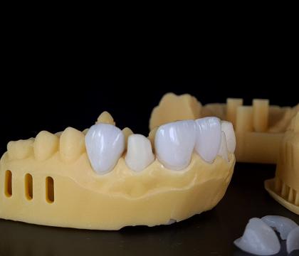 Licówki/korony/mosty