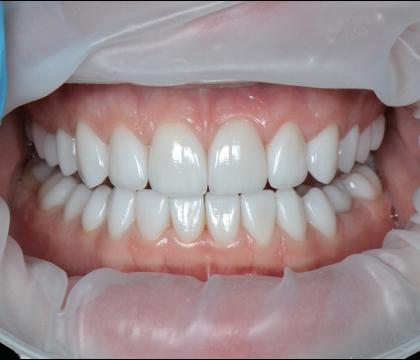 Całkowite protezowanie