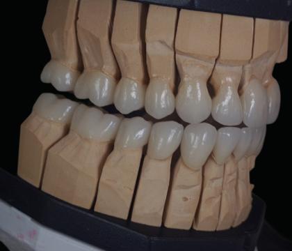 Całkowite protezowanie