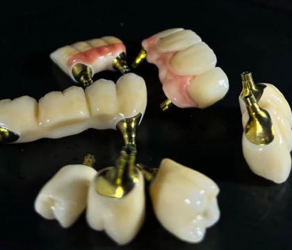 Protetyka na implantach