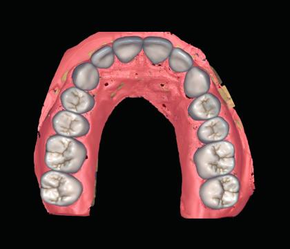 Całkowite protezowanie