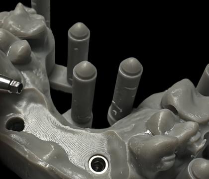 Protetyka na implantach