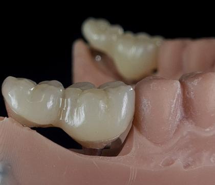 Protetyka na implantach